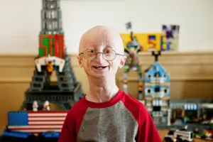 Sampson Berns el joven de 17 años que murió por envejecimiento